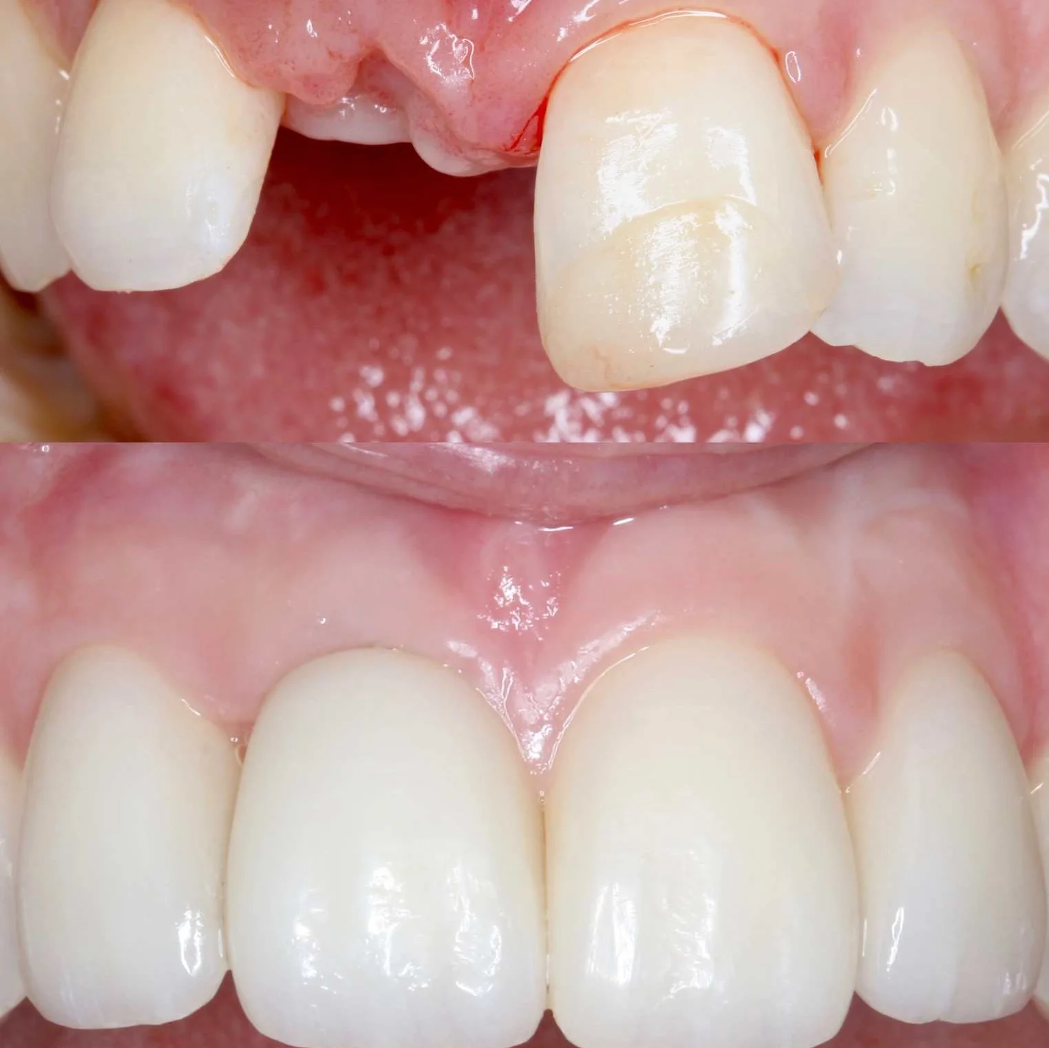 Before and after replacing a missing front tooth
